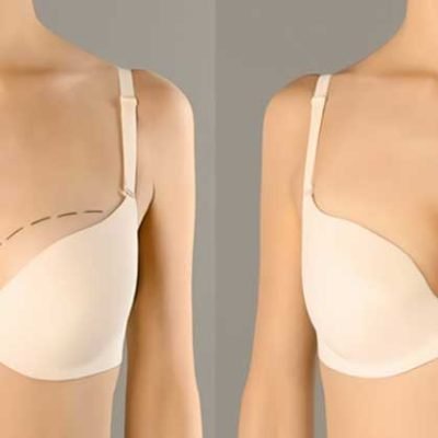Breast Implant Surgery Recovery Tips