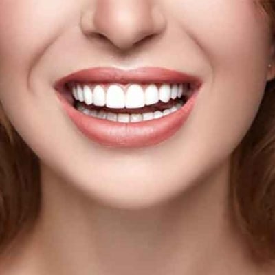 Can You Eat Normally with Veneers