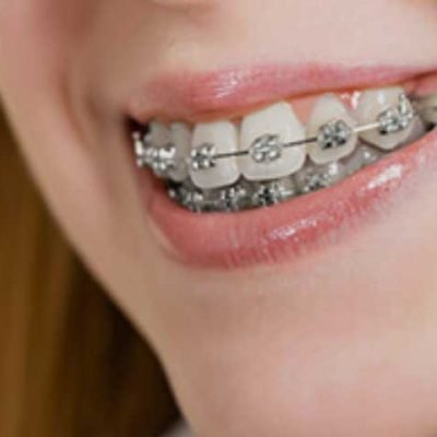Orthodontic Treatment for Overbites: What Are Your Options?