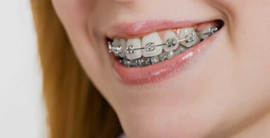 Orthodontic Treatment for Overbites: What Are Your Options?