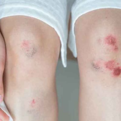 Exploring Soft Tissue Injuries and the Path to Negotiating a Settlement 