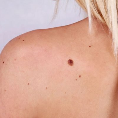 Warts vs. Other Skin Growths: How to Tell the Difference