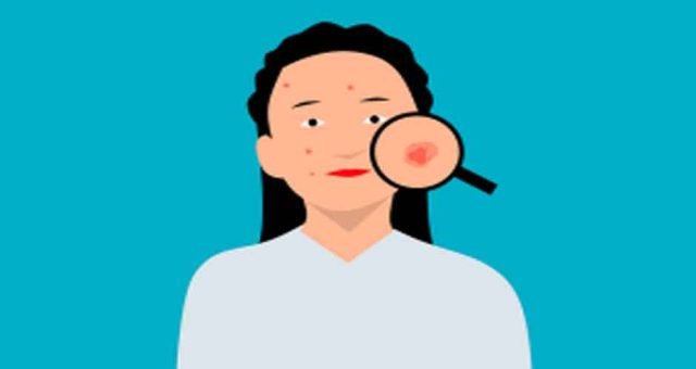 Brazen Skin Example How to Diminish Skin Blemishes - BrazenDenver
