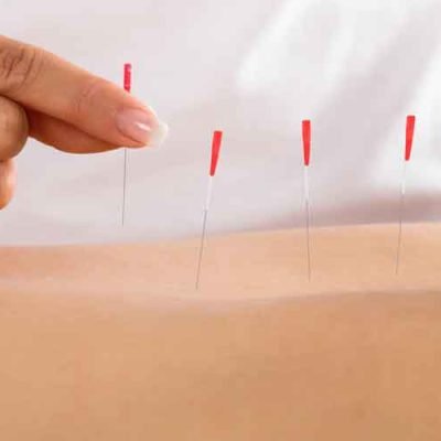 FAQs-About-Functional-Dry-Needling