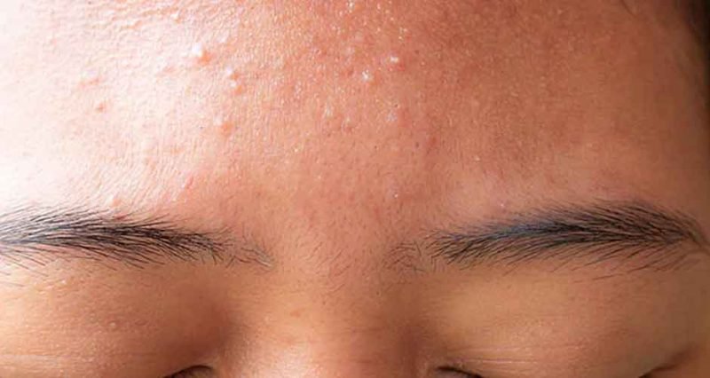 Brazen Skin Example How to Treat Acne on Oily, Dry, and Combination Skin - BrazenDenver