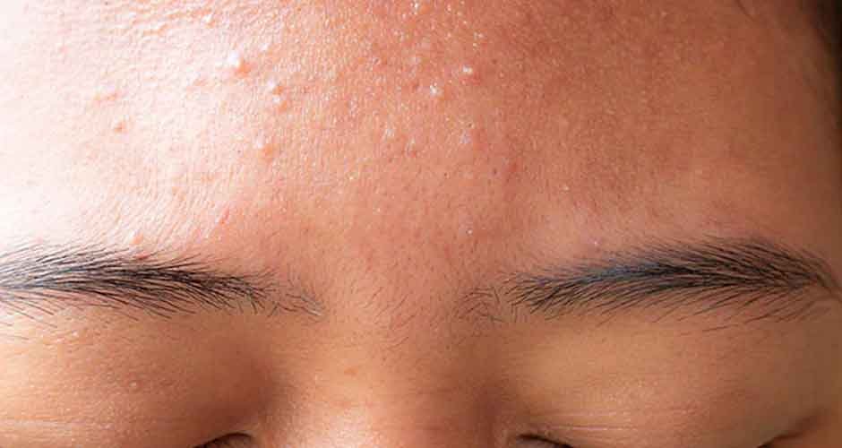 How to Treat Acne on Oily, Dry, and Combination Skin