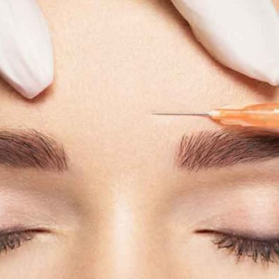 5 Things You Need to Know Before Getting Botox