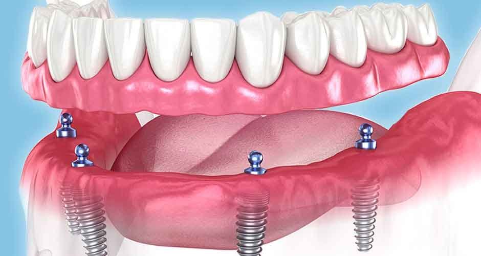 The-Concept-of-'Teeth-in-a-Day'-Procedures