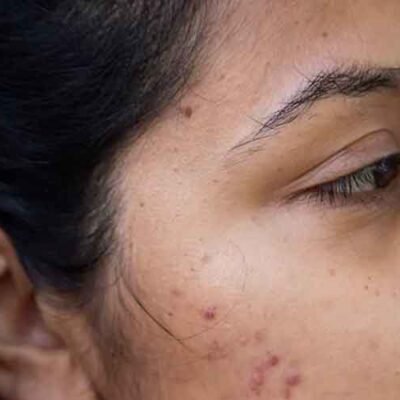 How to Remove Acne Scars – Expert Advice from a Dermatologist