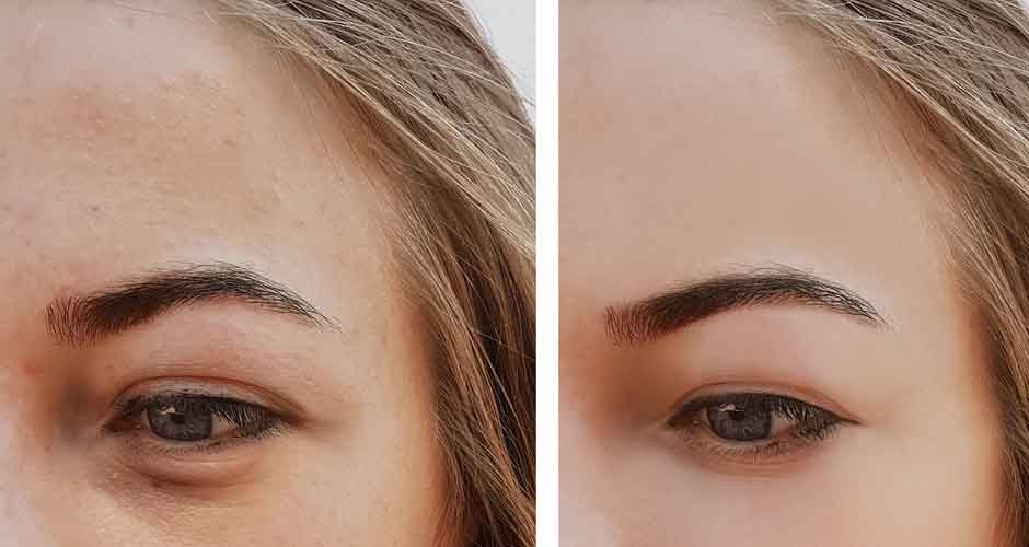 The-many-benefits-of-eye-filler-treatment