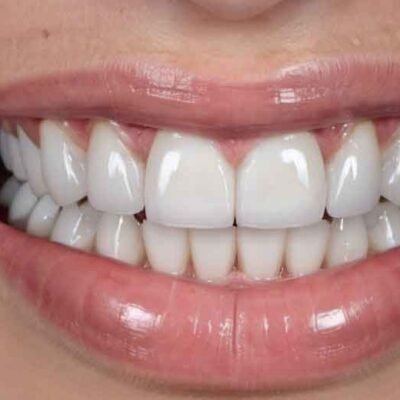 How-Porcelain-Veneers-Can-Change-Your-Smile-and-Confidence