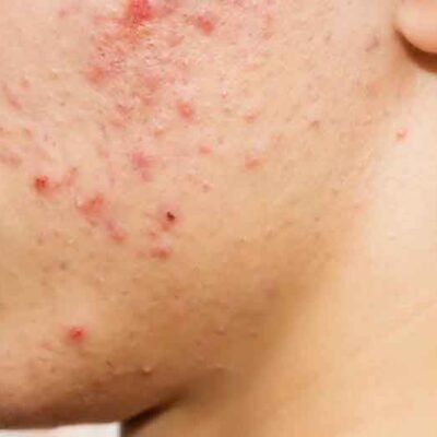 The-Global-Rise-of-Adult-Acne-What’s-Fueling-the-39%-Increase