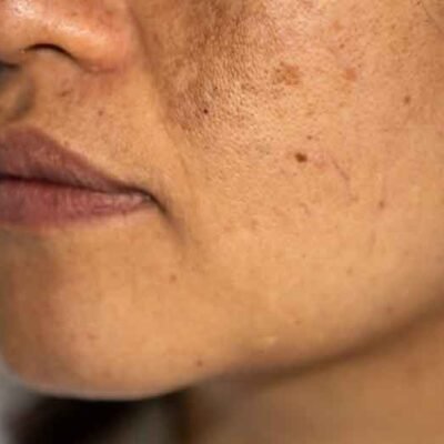 Why-Pigmentation-Is-One-of-the-Most-Common-Skin-Concerns-Among-Women-Over-30