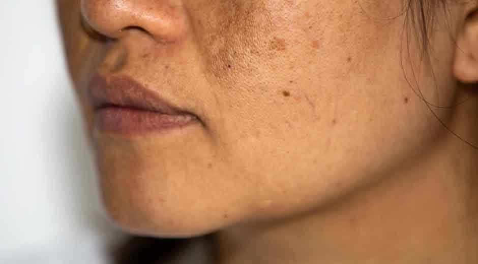 Why-Pigmentation-Is-One-of-the-Most-Common-Skin-Concerns-Among-Women-Over-30