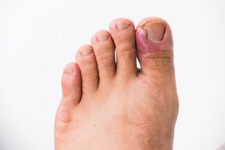 is-that-ingrown-toenail-in-auckland-actually-a-sig-1